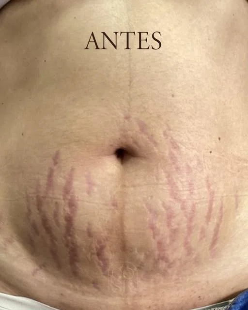 Antes del tratamiento de estrías en abdomen