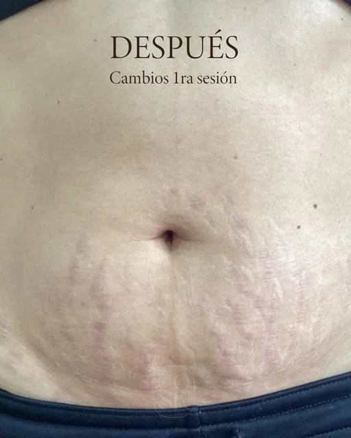 Después del tratamiento de estrías en abdomen