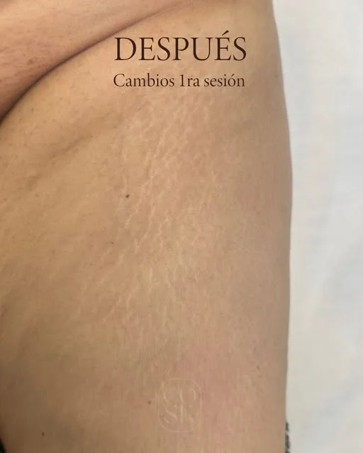 Después del tratamiento de estrías en pierna